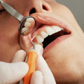 The Importance of Regular and Deep Dental Cleaning