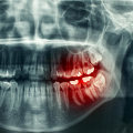 Understanding the Medical Terminology for Dental Health