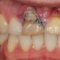 The Importance of the Rule of 4 in Pediatric Dentistry