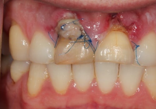 The Importance of the Rule of 4 in Pediatric Dentistry